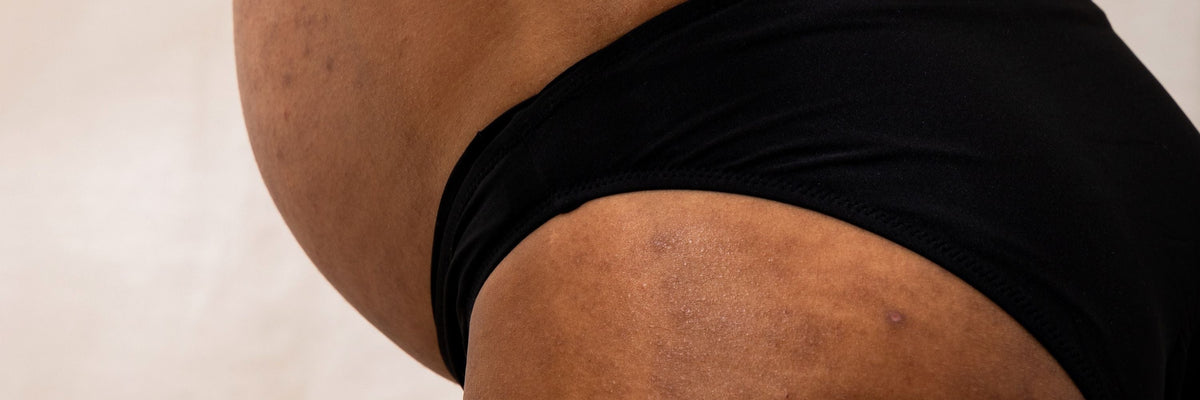 Allergique aux serviettes hygiéniques : pourquoi et que faire ?-Gapianne
