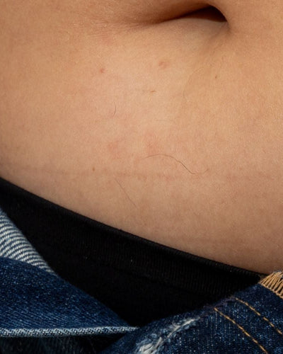 Les symptômes du SOPK