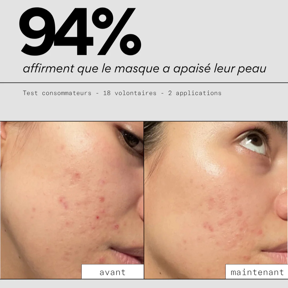 Masque apaisant pour les boutons - SKIN & OUT
