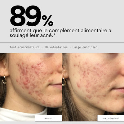 Complément alimentaire anti-boutons - Skin & Out