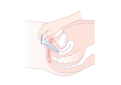 illustration insertion dilatateur vaginal Vagiwell - Gapianne
