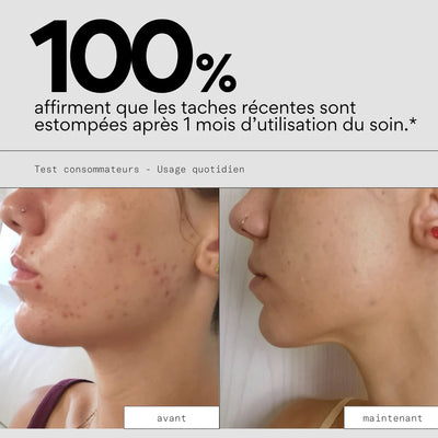 Soin anti-taches post-boutons - SKIN & OUT