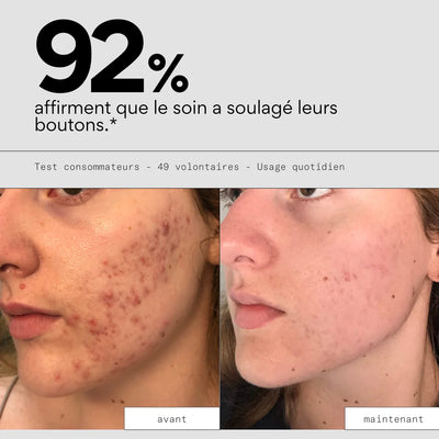 Soin anti-boutons aux prébiotiques - SKIN & OUT